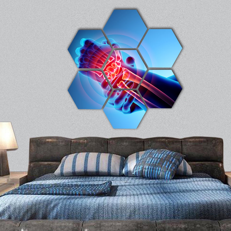Wrist painful, skeleton x-ray hexagonal canvas wall art