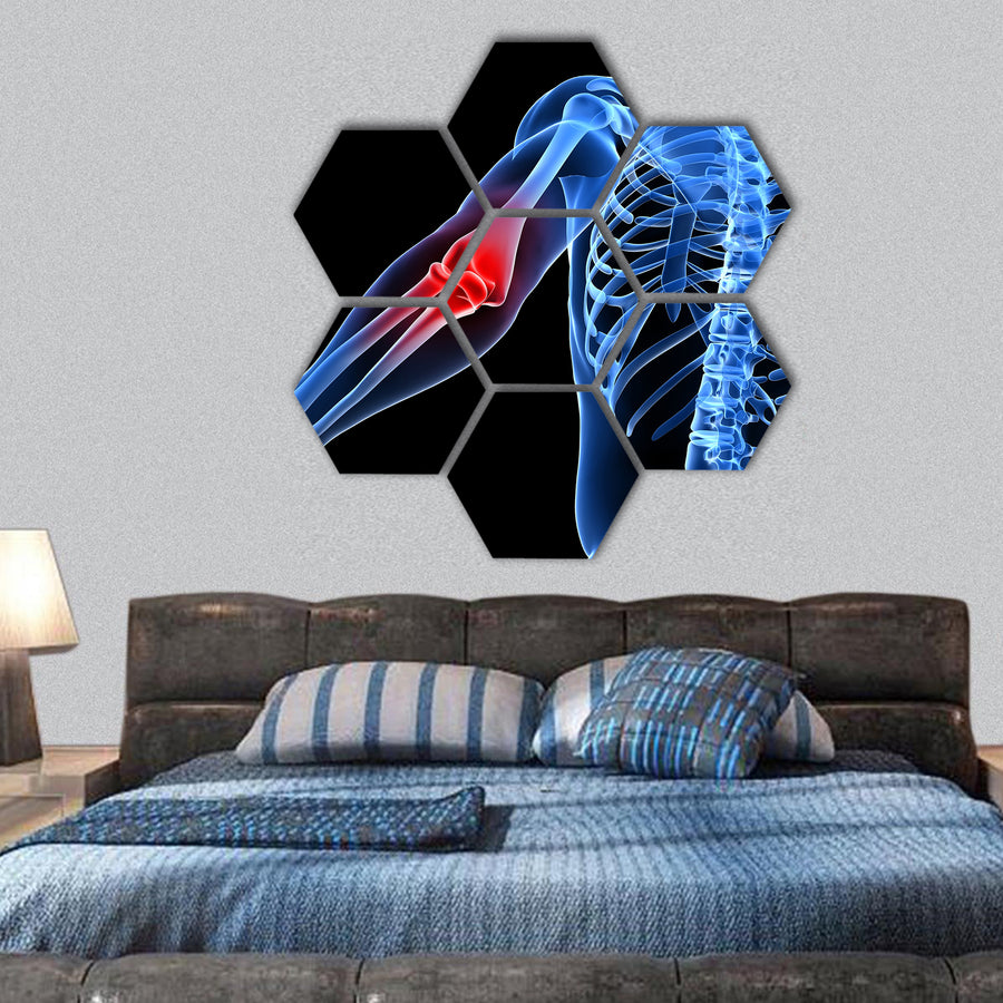 Painful elbow illustration hexagonal canvas wall art