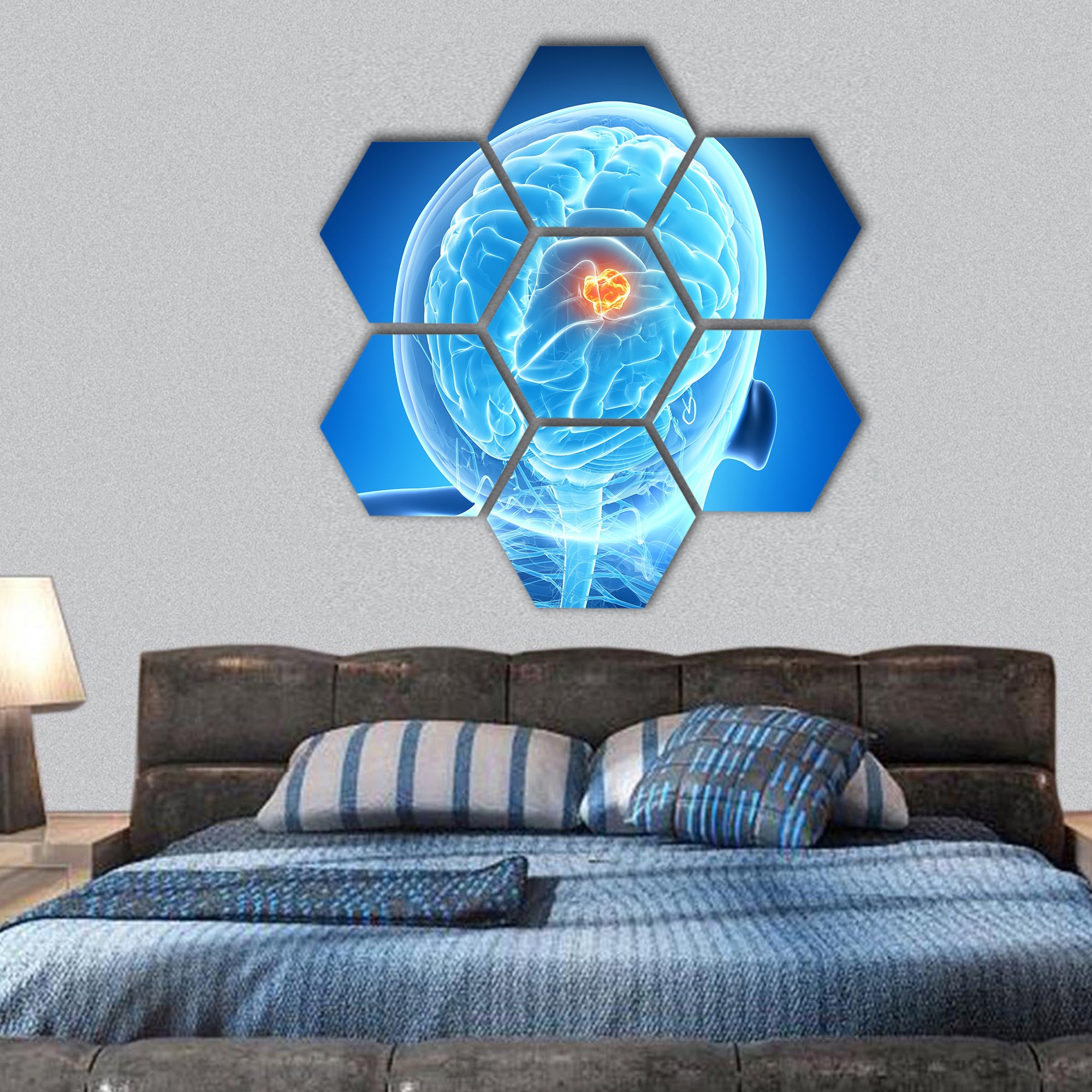 3d rendered illustration - brain tumor hexagonal canvas wall art