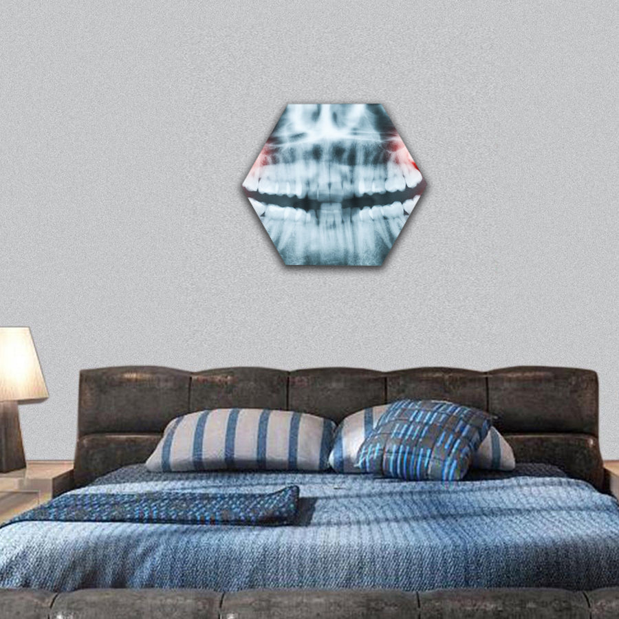 x-ray image of teeth and mouth with all four molars hexagonal canvas wall art